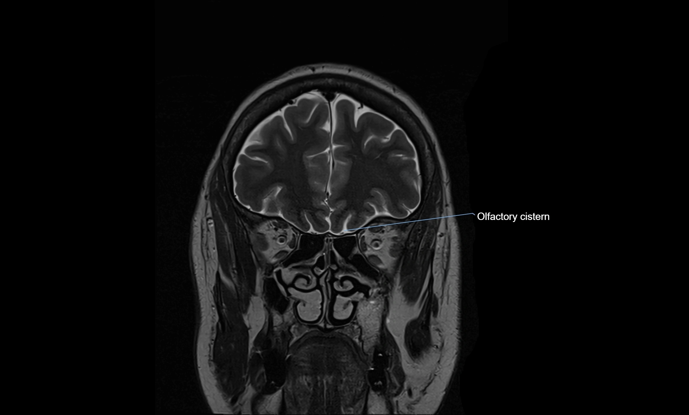 Brain cisterns  and ventricles coronal anatomy 3T MRI image-img-00001-00009.webp
